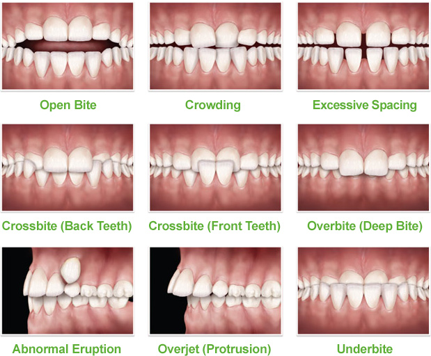 Ortodontik Problemlerin Sebepleri